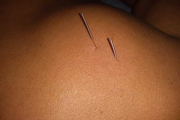 AGULHAMENTO A SECO